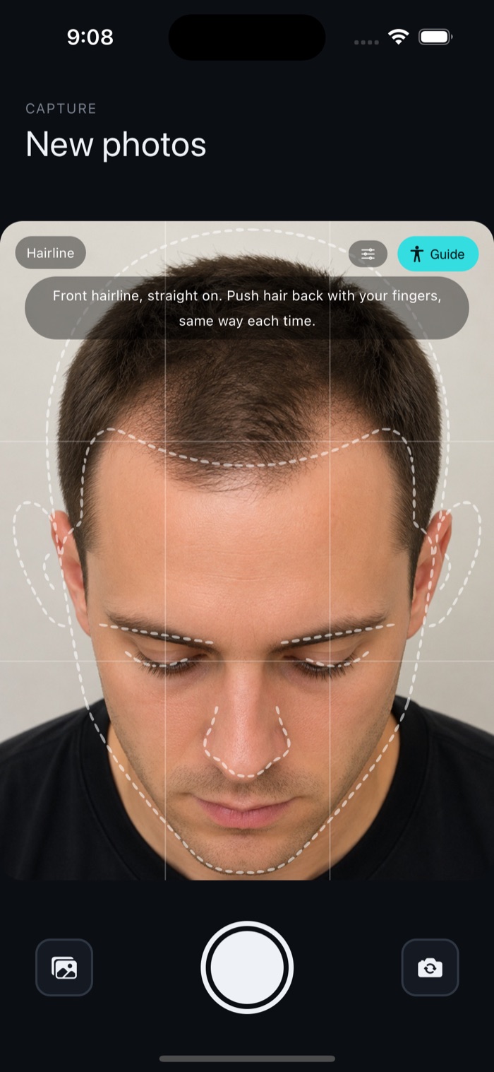 HairAgain camera with an alignment overlay for a repeatable hairline photo